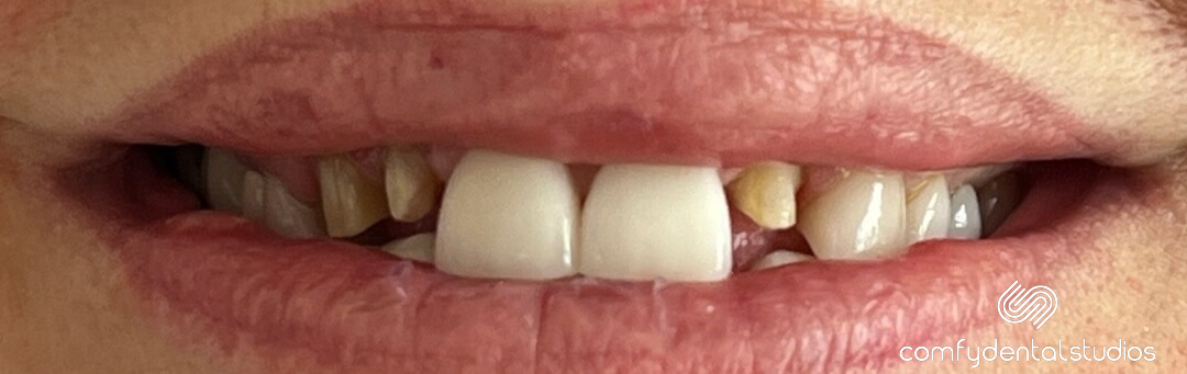 Before