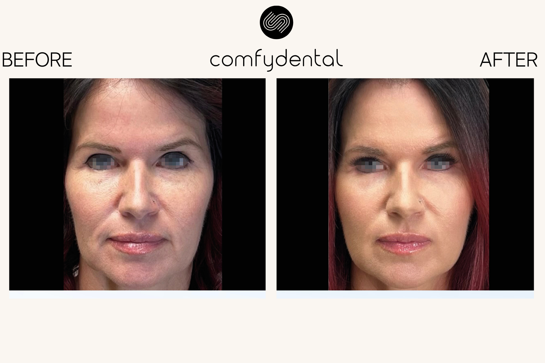 EMFACE Before and After