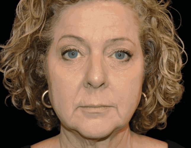 Emface & Exion After