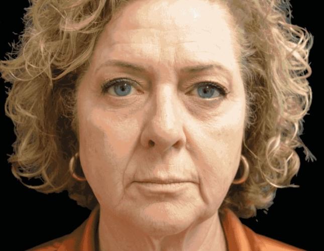 Emface & Exion Before