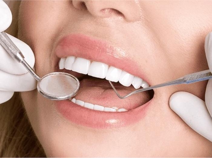 Veneers Aftercare