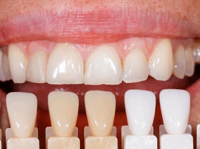 Veneers vs. Teeth Whitening