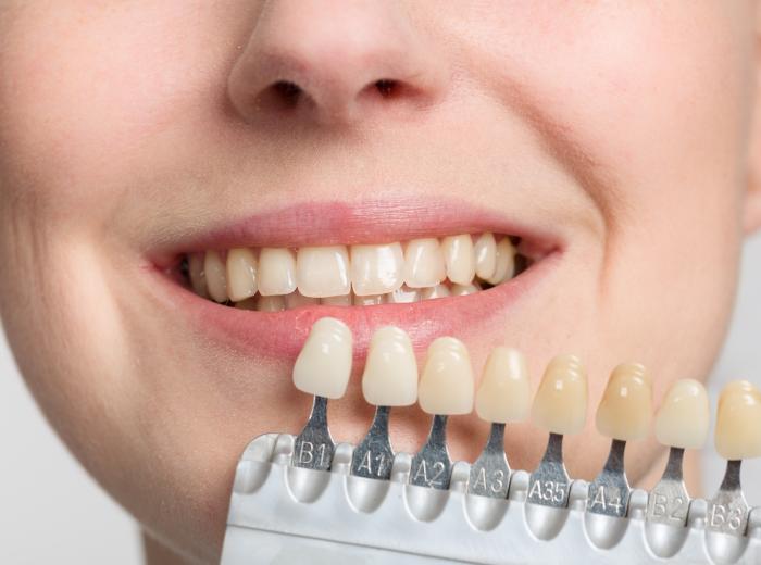 Veneers FAQ: The Most Common Questions Patients Ask About Porcelain Veneers