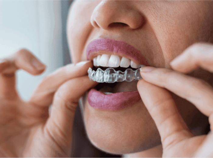 Invisalign vs. OrthoFX