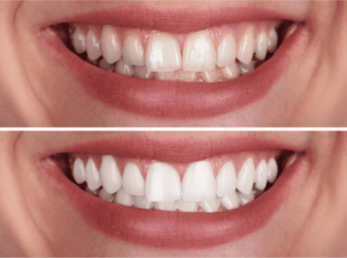 Professional Teeth Whitening in Beverly Hills