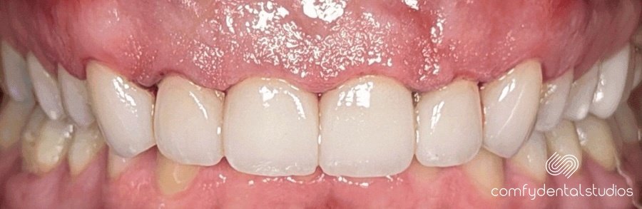 After veneers