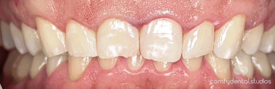 Before veneers